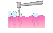 抜歯した隣の歯（支台歯）の成形