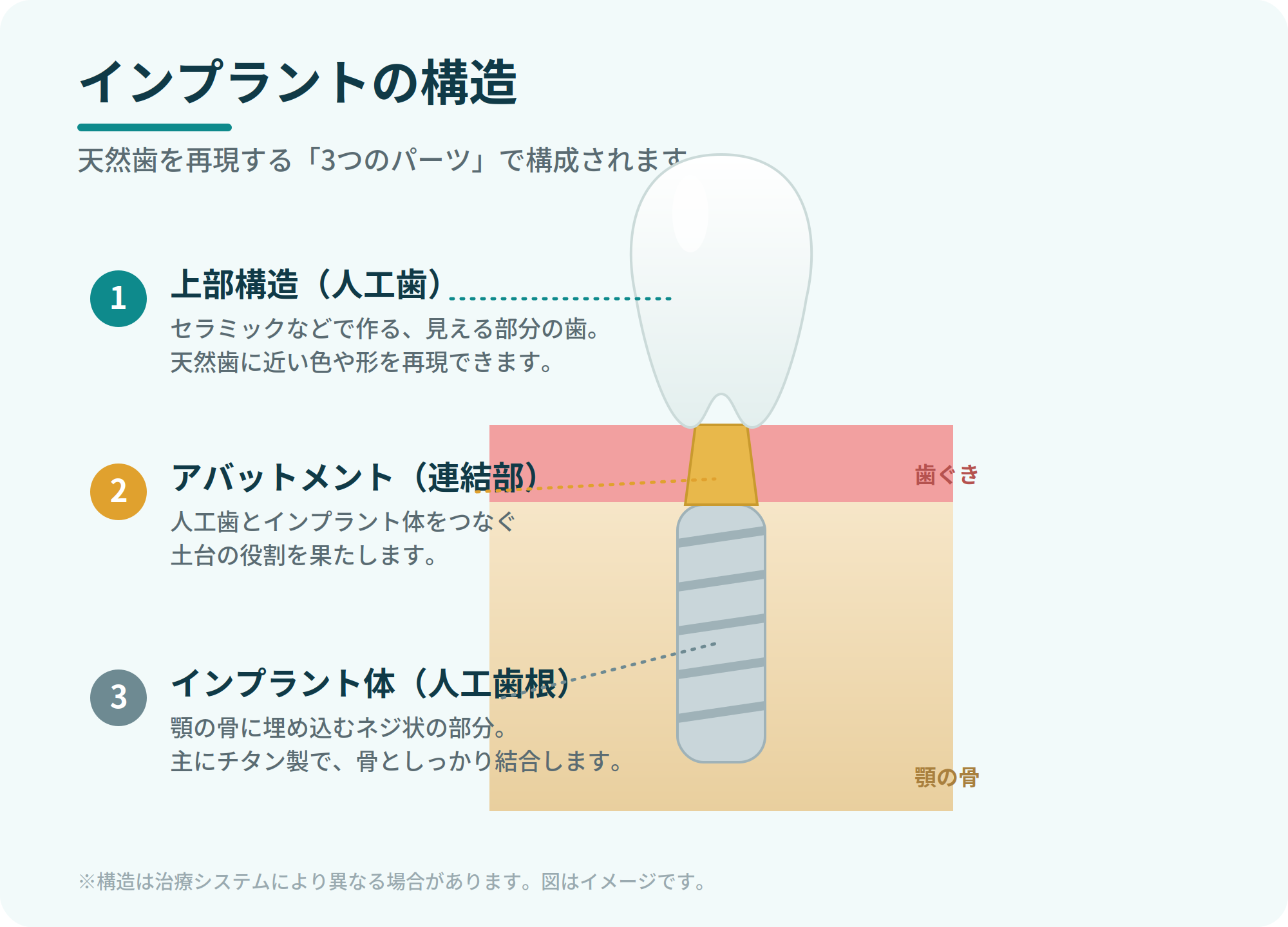 インプラントの構造図（上部構造・アバットメント・インプラント体の断面イラスト）
