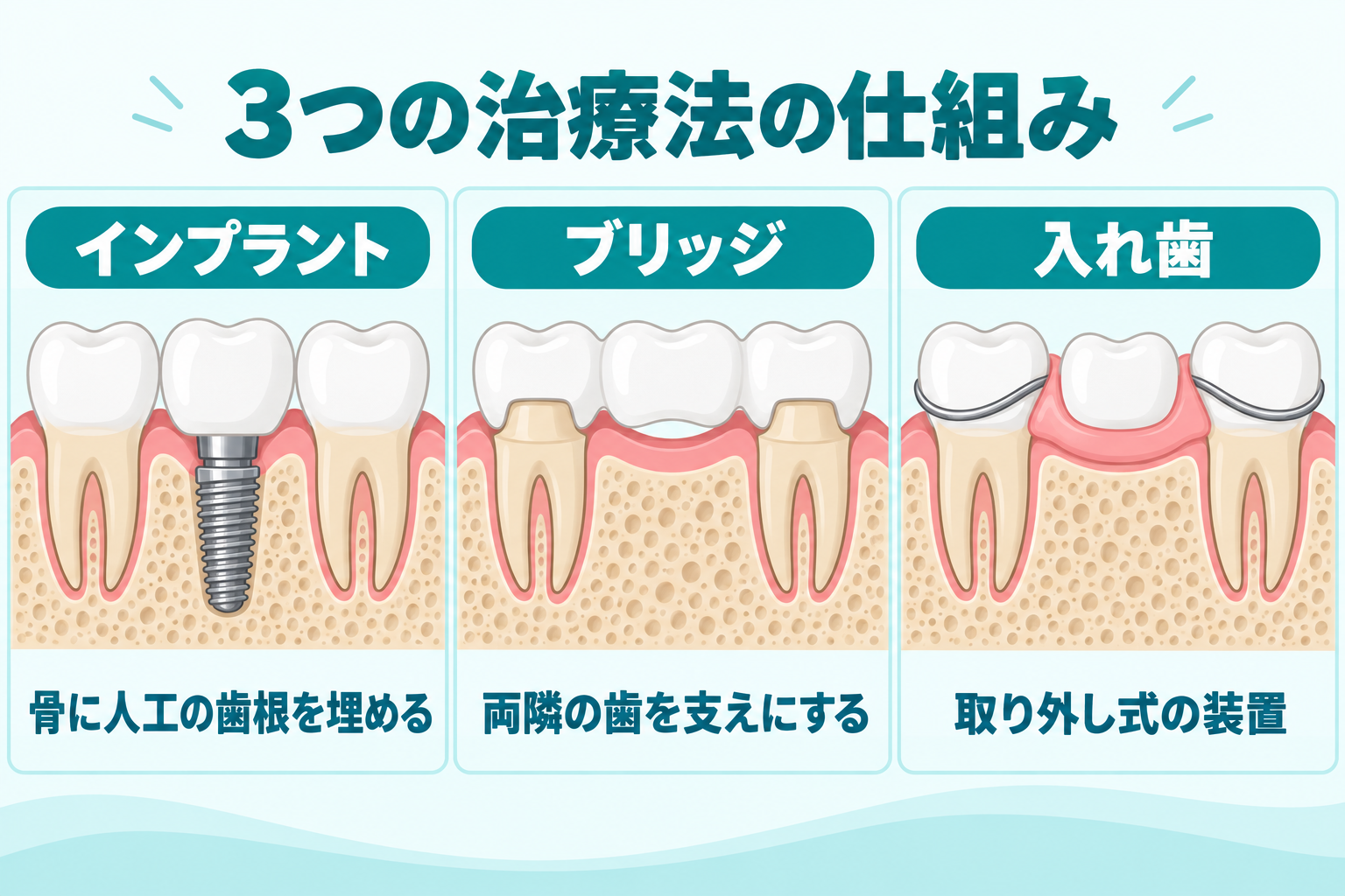 インプラント・ブリッジ・入れ歯の仕組みの図解。インプラントは骨に人工の歯根を埋める、ブリッジは両隣の歯を支えにする、入れ歯は取り外し式の装置