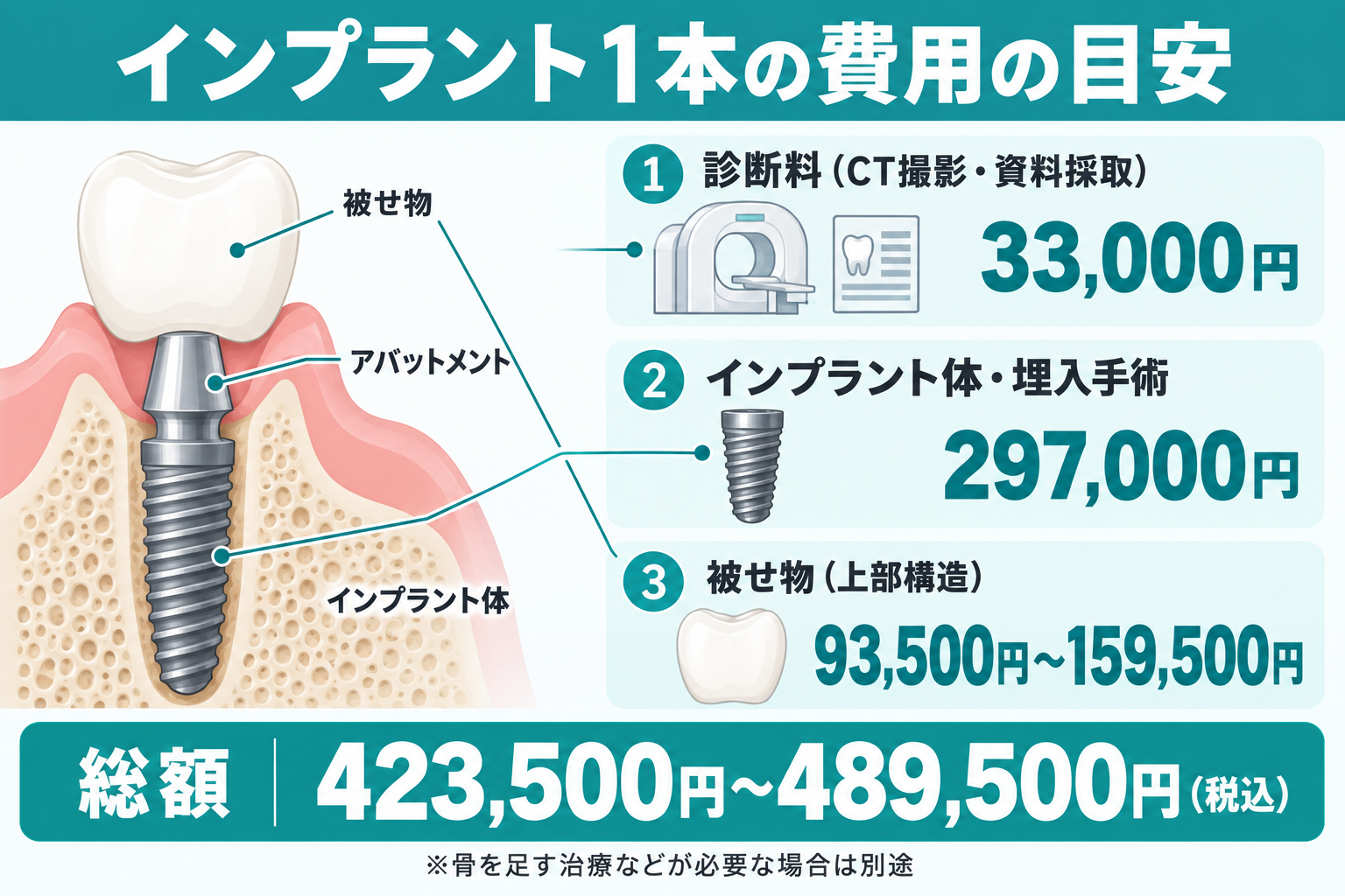 インプラント1本の費用の内訳。診断料33,000円、インプラント体・埋入手術297,000円、被せ物93,500円〜159,500円。総額は税込423,500円〜489,500円