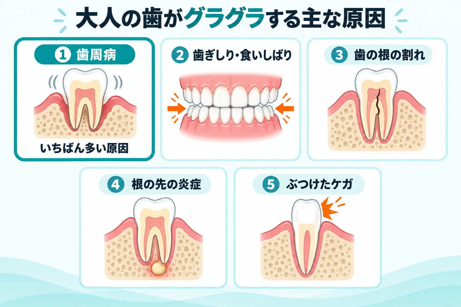 大人の歯がグラグラする主な原因の図解。歯周病、歯ぎしり・食いしばり、歯の根の割れ、根の先の炎症、ケガ