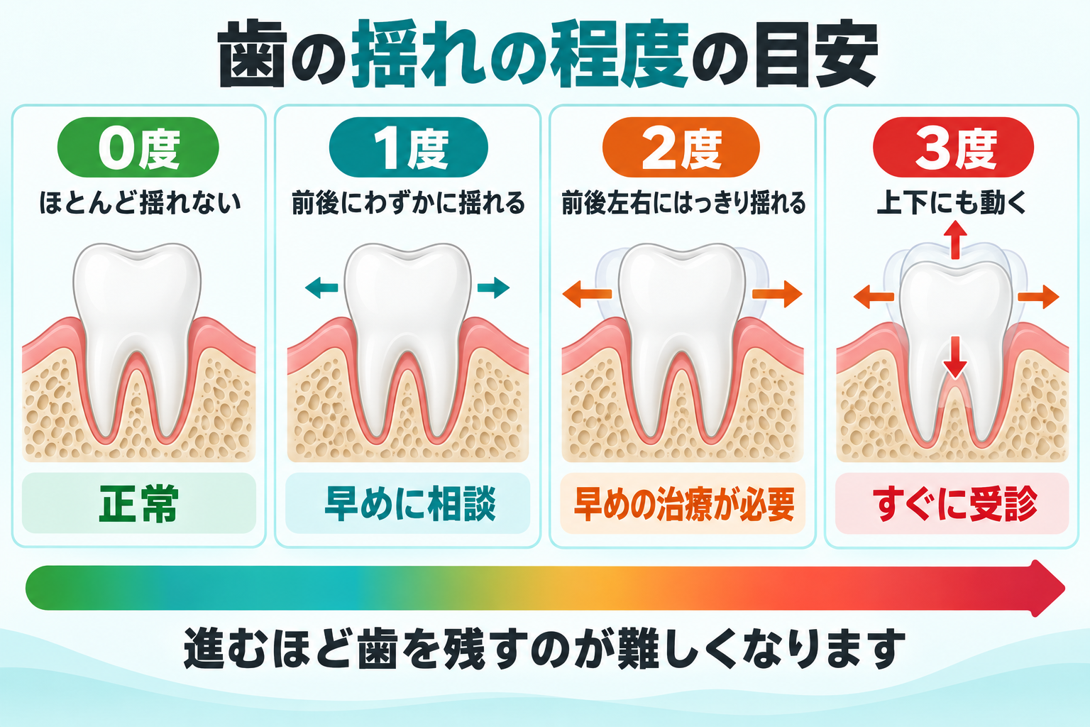 歯の揺れの程度の目安。ほとんど揺れない、前後にわずかに揺れる、前後左右に揺れる、上下にも揺れるの4段階